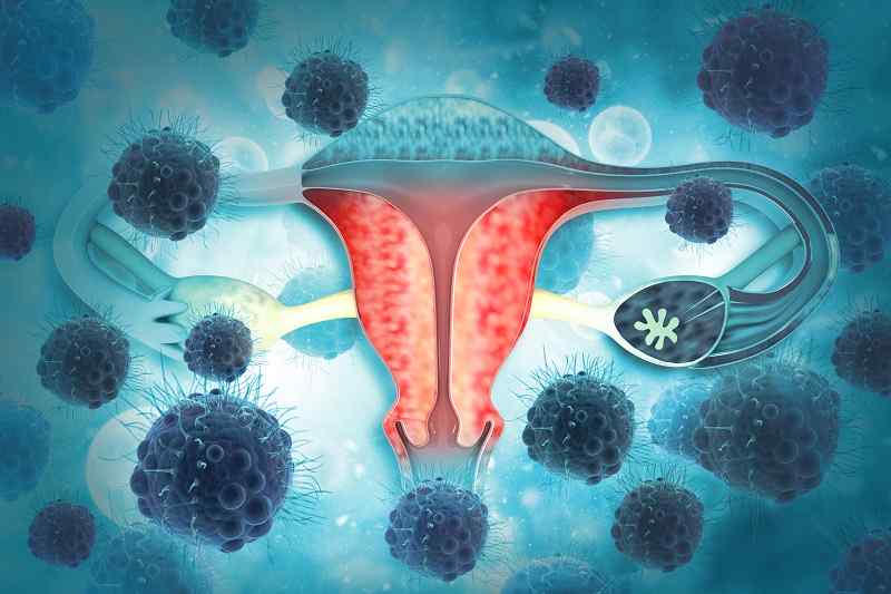 How is Stage 4 Ovarian Cancer Treated?