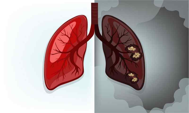 Is It Possible to Treat Stage 4 Lung Cancer?